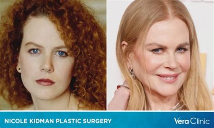 Nicole Kidman Breast Implants Plastic Surgery Before and After Celebie